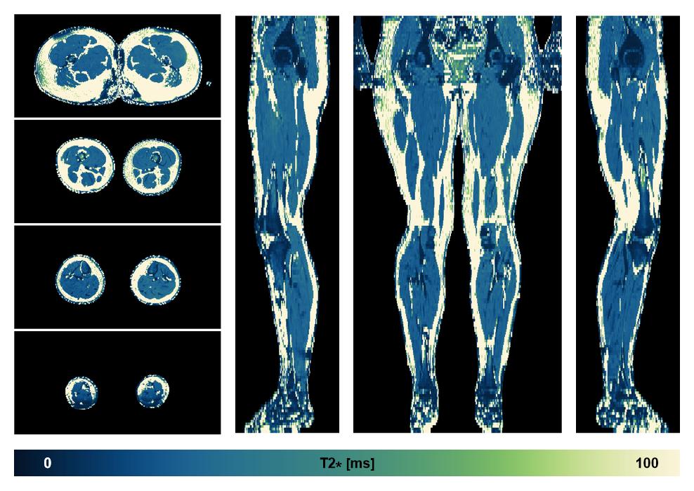 The T2 star relaxation time of the lower extremity obtained from the dixon reconstruction for muscle water fat quantification.